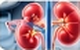 Organ Transplant